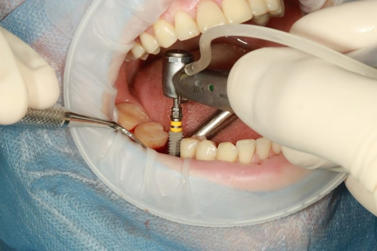 Pérdida dental: Los implantes un como un tratamiento exitoso