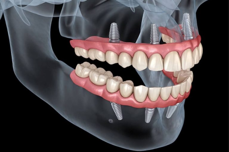 Sistema All On Four: ¿puedo recuperar mis dientes en un día?