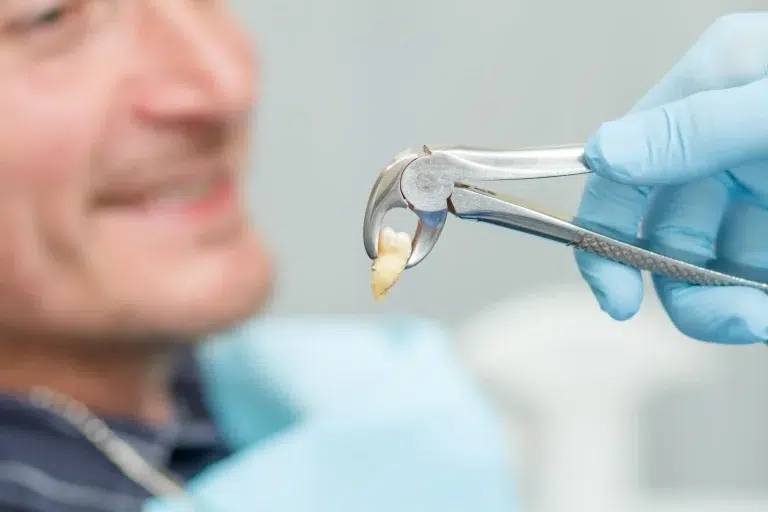 Extracción dental: Cómo cuidar tus dientes después de la cirugía
