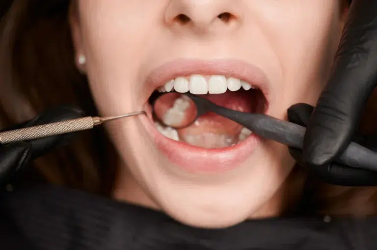 Caries dental ¿Puede ocultarse bajo un empaste?