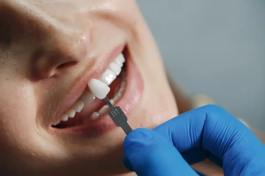 Estetica-dental-Carillas-dentales-pisa-clinica-dental-mairena-del-aljarafe-sevilla