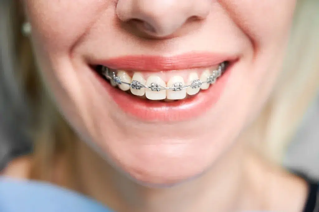 ortodoncia de brackets-pisa clinica dental-mairena del aljarafe sevilla