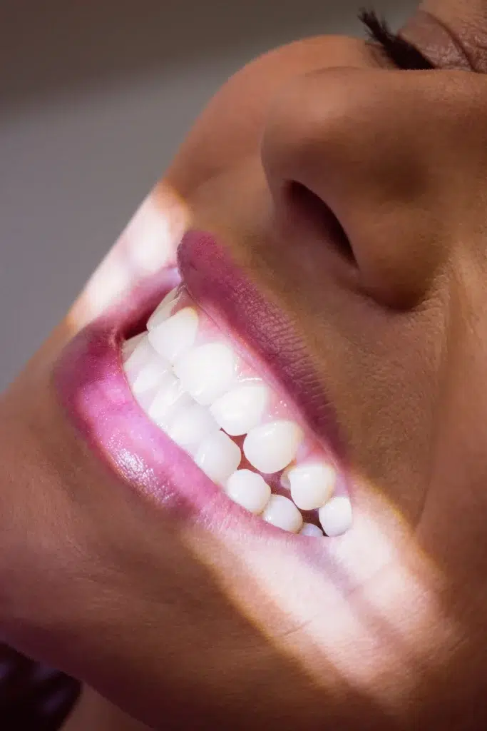 blanqueamiento dental en mairena del aljarafe - pisa clinica dental
