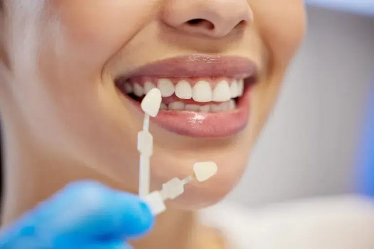 1 / 1 – carillas dentales en mairena del aljarafe pisa clinica denta