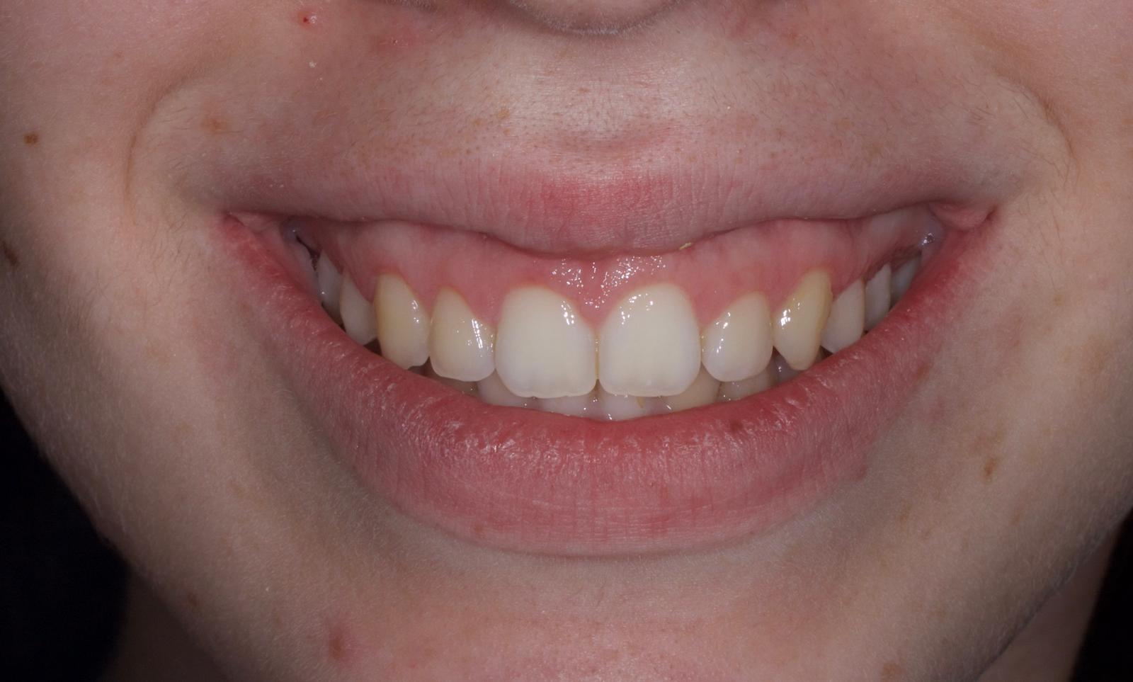 resultado de ortodoncia en mairena del aljarafe pisa clinica dental