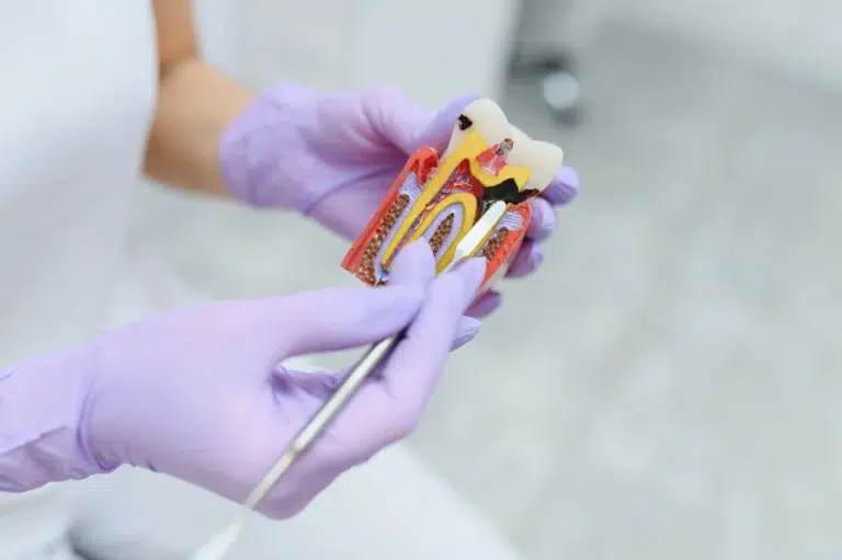 Perno Dental duele endodoncia en mairena del aljarafe sevilla pisa clinica dental