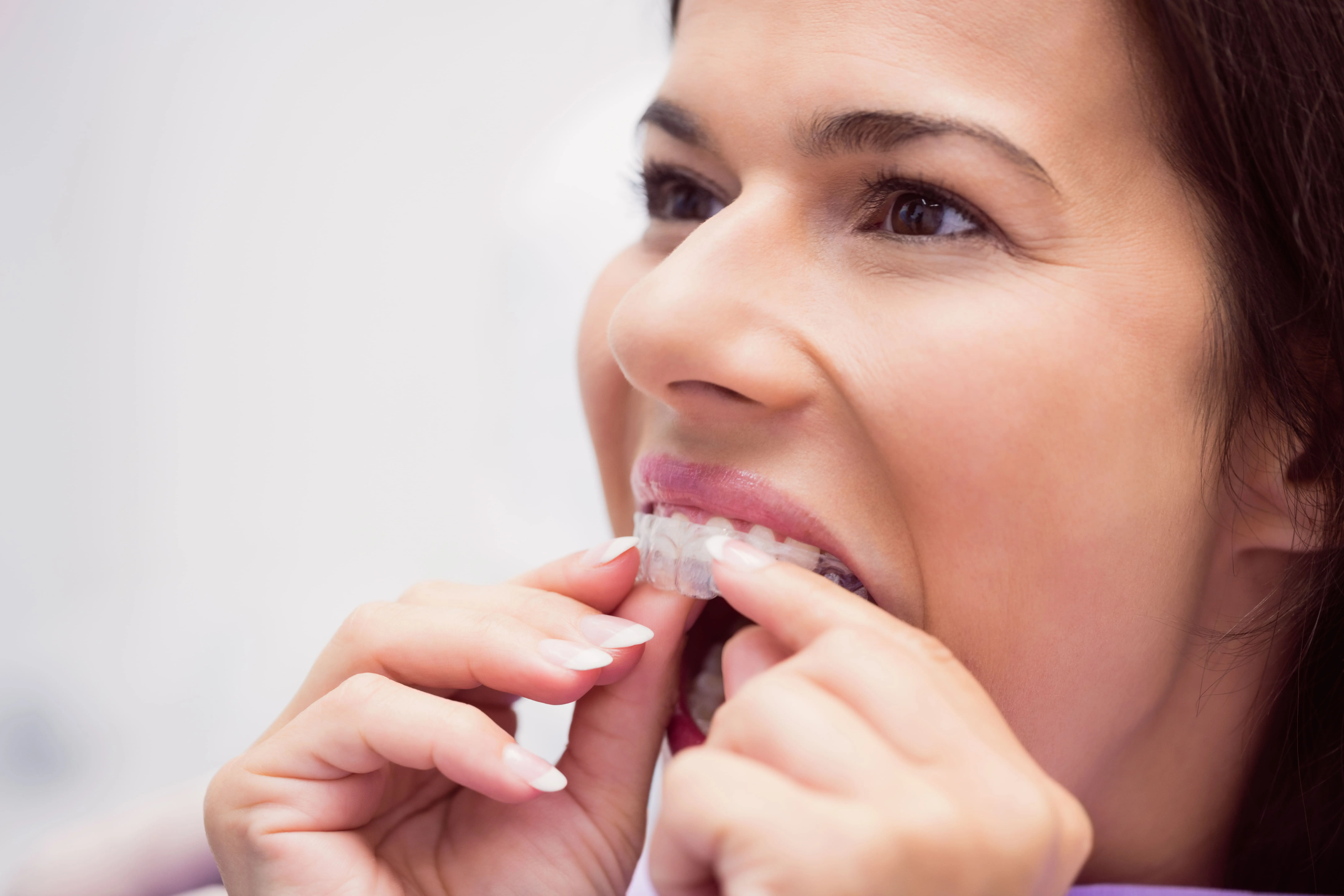 El Precio De La Ortodoncia Invisible En Mairena Del Aljarafe Y Sus Beneficios pisa clinica dental