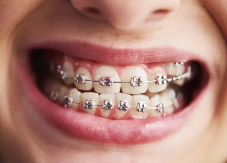 alinear dientes Ortodoncia en mairena del aljarafe pisa clinica dental