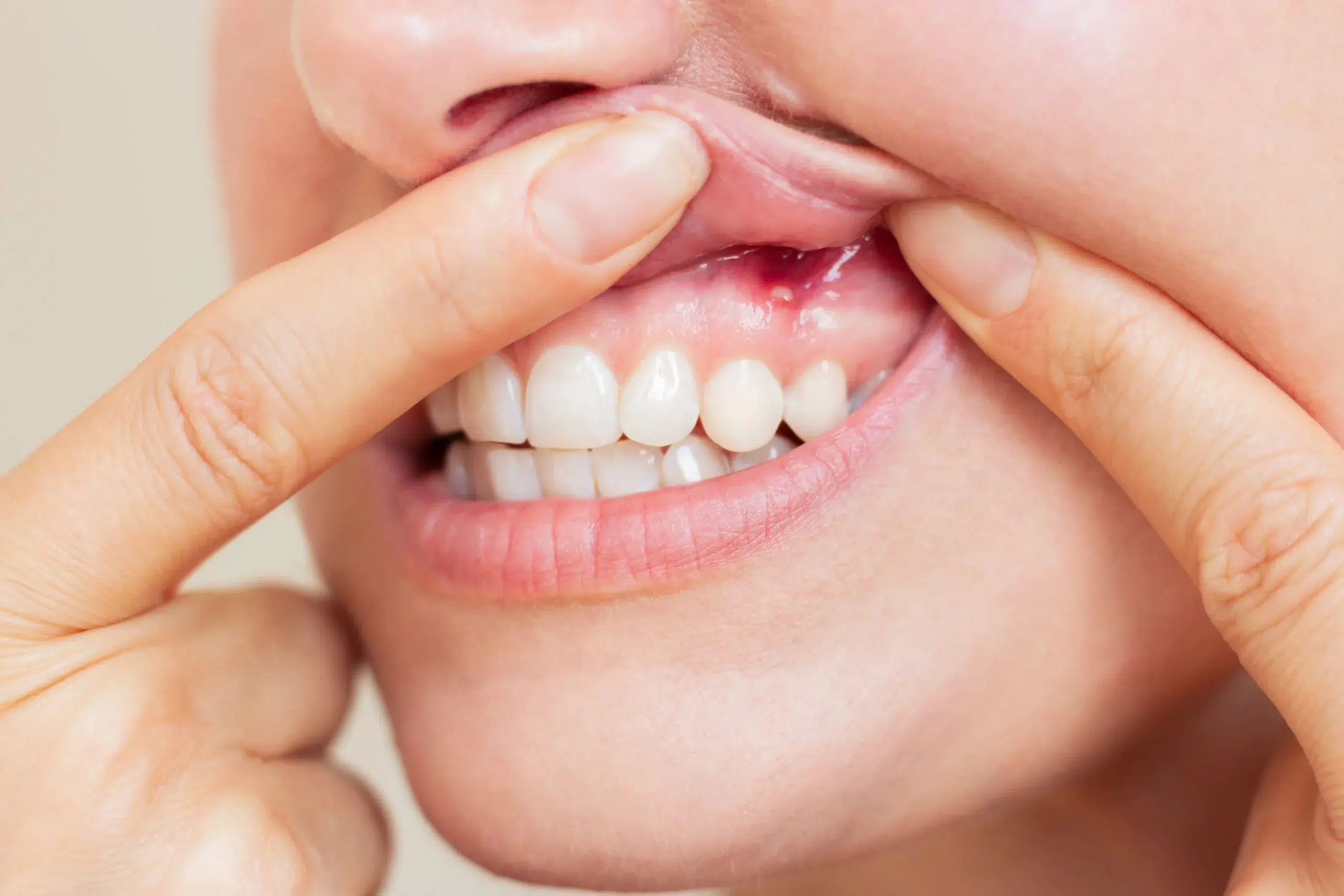 Periodoncia En Mairena Del Aljarafe Para El Tratamiento Del Sangrado De Encías pisa clinica dental