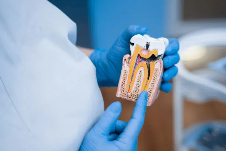 Cuándo es necesario repetir una endodoncia reendodoncia en mairena del aljarafe pisa clinica dental