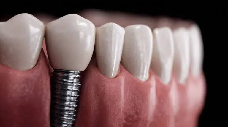 Implantes de carga inmediata qué son y quién puede optar a ellos en mairena del aljarafe pisa clinica dental